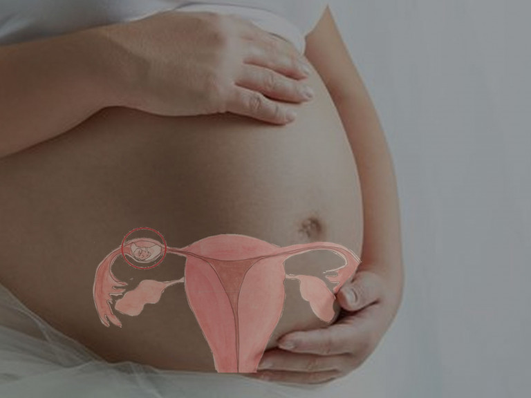 Embarazo-ectópico ginecoactual.com.mx